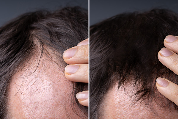PRP and exosome hair therapy